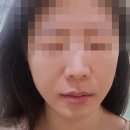 뉴젠메디칼 킴(KIM) | ●강남역 피부과● 티타늄 리프팅 후기 (원리, 통증, 부작용, 가격 정보)