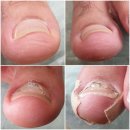 오니크네일 | [서울/강서] 마곡 발산 문제성 내성발톱 교정하고 발이 편해진 후기 <디에고푸스 오니크네일 화곡점>