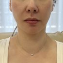 엔데버빌딩 | 강남역 피부과 써마지 대체 셀리뉴와 코레지 리프팅 후기