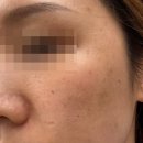 오가예의원 | AESTHETIC : 발산역 오가예의원_브이로니들RF+쥬베룩스킨 2주 후 솔직후기+내돈내산, 발산피부과 추천