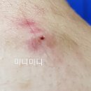 합천읍 합천초등학교+합천약국 | [내돈내산] 합천군 바른윤내과의원 피부과 피지낭종 제거 후기
