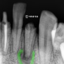엘리트치과기공소 | 신촌치과 변색된 아래 앞니, 치아 뿌리 염증, 재 신경치료 후 크라운