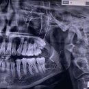 판교이화자연약국 | 홍대 사랑이아프니 매복 사랑니 발치후기