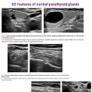US features of normal parathyroid glands 이미지