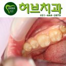 구리허브치과 티스토리