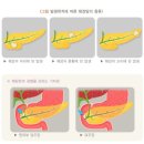췌장암 진단을 받고 췌장을 70%이상 잘라내었을 때 2022년 3월에 가입한 보험계약에서 장해보험금을 받을 수 있습니까? 이미지