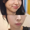 중로2-600 | [대전] 예비신부 볼패임 걱정없는 올타이트리프팅 키닥터 내돈내산 솔직후기