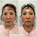 쌩쌩한의원 | 부모님 효도시술 팽팽의원 실리프팅 당일후기 알아봐요! (내돈내산, 실리프팅 가격, 통증)