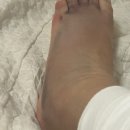 유나이티드병원 | 출근 중 넘어져 제5중족골 골절, 미사 유나이티드병원 산재 수술부터 철심 제거까지 솔직 후기