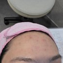 바름한의원 | 홍대여드름 한의원 방문기 : 율각테라피 후기