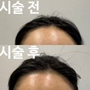 투엠 | [강남/역삼 반영구] 헤어라인 무통증 반영구 투엠메이크업 내돈내산 후기