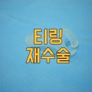 뉴맨남성의원 | 티링 교체 재수술 가능할까요?
