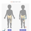 발달성 내반 고(Developmental Coxa Vara) : 질병정보 이미지