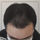 모나와 | 모나와 대전헤어라인 시술 후기 자연스럽게 자신감이 살아난 경험