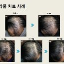 더모헤어플란트피부과의원 네이버블로그