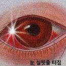 눈 실핏줄 터짐 원인과 눈에 핏줄(혈관) 터졌을 때 대처 방법 : 결막하출혈 이미지