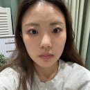 브이맨비뇨기과의원 | 강남윤곽주사 잘하는곳에서 이중턱살제거 성공한 내돈내산 후기