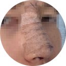 코코온누리약국 | 코젤코 내돈내산 수술 당일후기, 비앤영의원 김인상원장님 2탄