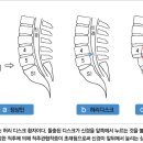 생활습관병 관리 - 척추 : 척추관협착증 증상 이미지