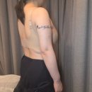 상체지방흡입 회복과정, 팔뚝·부유방지방흡입 후기