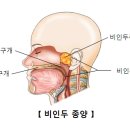 비인두 종양[Nasopharyngeal tumor] 귀코목질환, 종양혈액질환 이미지