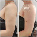 르브아 에스테틱 | [뷰티] 계룡피부관리 르브아에스테틱 팔뚝슬리밍관리후기