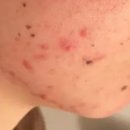 피피엠 | 애크논크림 쓰며 같이 쓴 아이템 후기