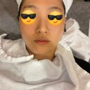 턱시 | 결혼 전 신부관리, 투턱관리, 투턱시술) 피팅리프팅 내돈내산 후기, 추천? 비추천?