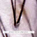 두피열 내리는법 여름에는 이렇게 해요