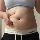 경산아지매 | 경산 복부 지방추출주사 13일차 후기 (전후사진, 시술 당일 꿀팁 있음)