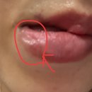 화남(아) | 배곧 피부과 입술필러 및 인모드 후기 내돈내산(+화남주의)(결국 입술필러 녹임)