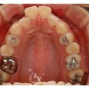 돌출된 치아를 라미네이트 치아성형 과 치아교정으로 해결하기 이미지
