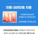 사상역치과 잇몸이식 수술후기 개선 과정