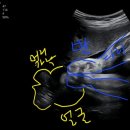 농산물미트 | 임신 36주차~임신 38주차 증상 : 임신소양증, 색소침착, 역아(둔위) 제왕절개 예약, 임산부 마지막진료