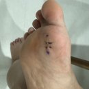 천보성 | 발바닥 혹 낭종 제거 후기 , 꼭 전문 병원 가세요