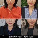 프라임21 | 울쎄라 후 통증 붓기 일주일 울쎄라 프라임 300샷 총정리