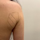 퍼팻 | 빼기 힘든 뒷날개살 이오팻주사로 지방분해 효과 본 후기