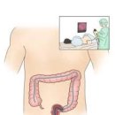 대장내시경 전 음식 수면내시경 비수면내시경 대장내시경 확인가능질환 주의사항 이미지