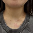 소은한의원 | 평편사마귀, 쥐젖 제거 후기(포메디한의원)