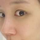 여름의원 | 강남역피부과 울쎄라 + 티타늄 리프팅 여름의원에서 받은 솔직후기