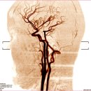 '뇌혈관'이 막히면 나타나는 증상 이미지