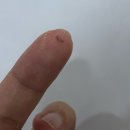 티나성형외과의원 | 아이라인 문신 제거 #내돈내산 후기 , 강남 컴포트성형외과 (붓기 , 멍 , 가격인상)