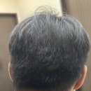 누구나 할 수 있는 헤어커트 | 원형탈모증 원인, 초기 병원 피부과 주사, 대전 머리헤어 커트, 완치 후기