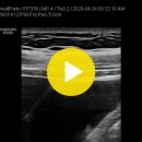 담낭 용종(GB polyps) 이미지