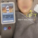 성동구 옥수동피부과 미글로우리프팅 후기✨ 처진 턱선 라인관리