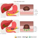 고도 비만으로 위 80% 절제한 경우 2024년 6월에 가입한 개인보험 후유장해 받을 수 있습니까? 이미지