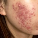 아젤리아 | (사진후기) 아젤리아크림 흉터 따가운연고 성분 비교