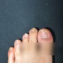 포시즌헬스 | [신촌 네일포시즌 풋풋한리쌤] 서울 내성발톱 치료 내성발톱 와이어 교정기 후기