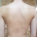 미강 | 등드름 흉터 제거 미강약침 받은 후기