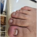 조치원 주차타워 | 공주시 조치원 내성발톱 아픈발톱 관리는 여기, 발데렐라 // 내성발톱 무좀발톱 발각질